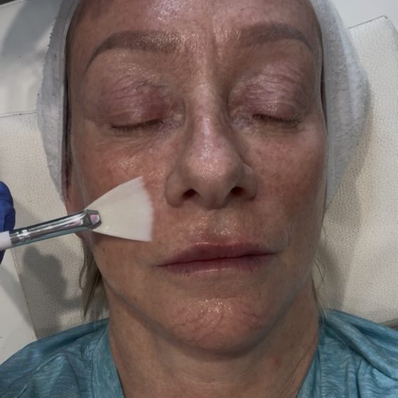 Aesthetics By Luisha | Chemical Peels In Derby, UK