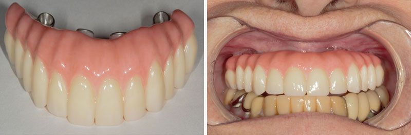 Full Arch Implant