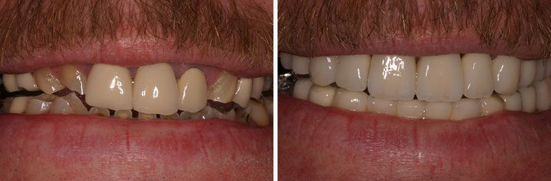Smile Makeover - Before & After