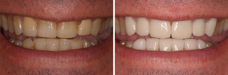 Smile Makeover - Before & After