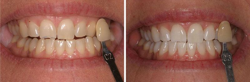 Teeth Whitening - Before & After