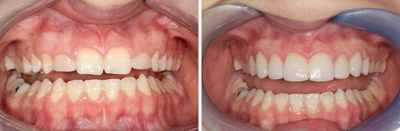 Before & After - Veneers