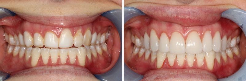 Before & After - Veneers
