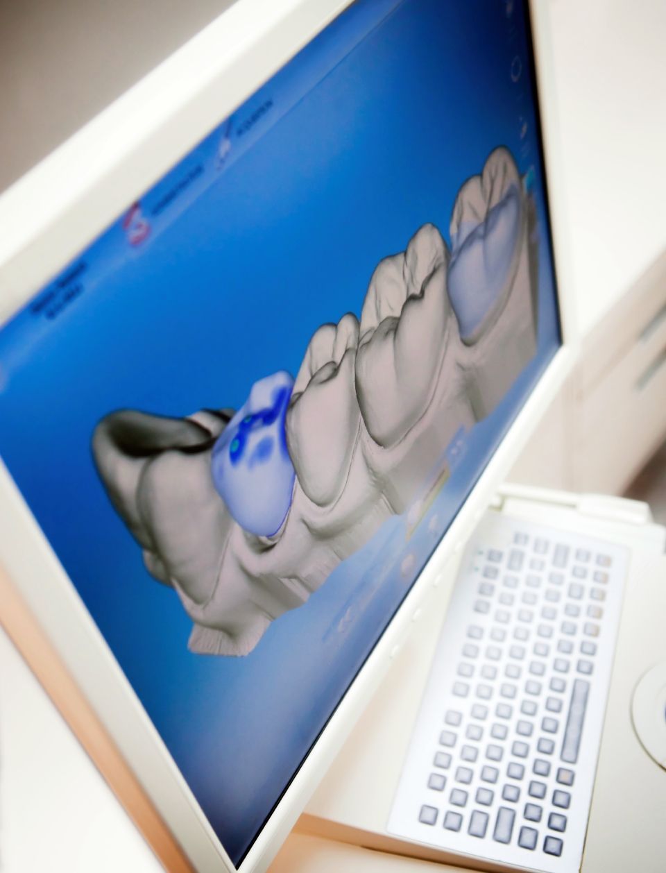 rappresentazione grafica di impianti dentali
