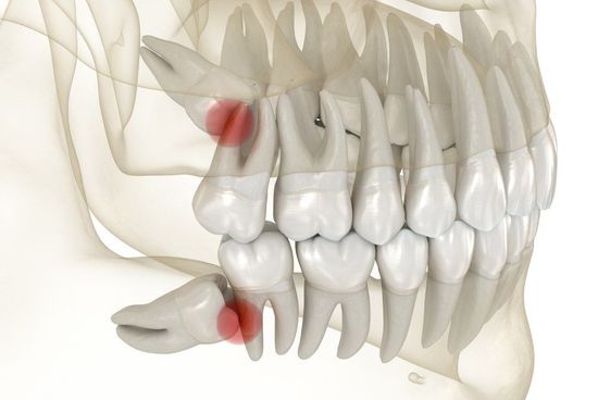 denti del giudizio di entrambe le arcate