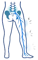Lower body diagram showing sciatic nerve pain from lower back to leg, with blue nerve highlighted.