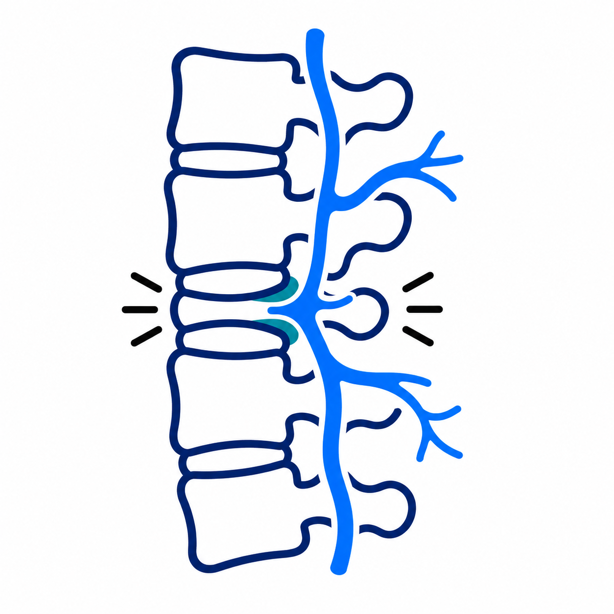 Blue spine illustration with a pinched nerve in the lower back causing pain marks