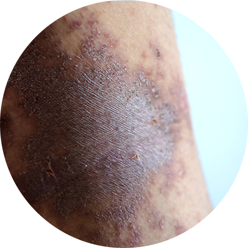 Port Wine Stain Birthmark Treatment