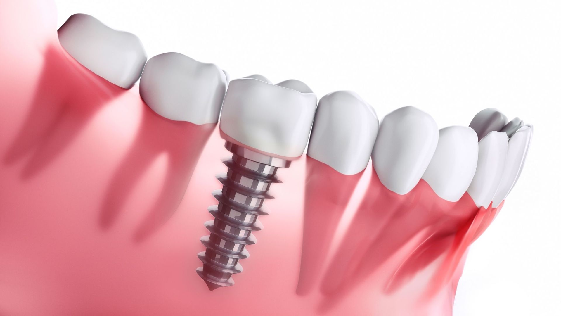 Dental implant: screw in jaw with attached crown, next to natural teeth and red gums.