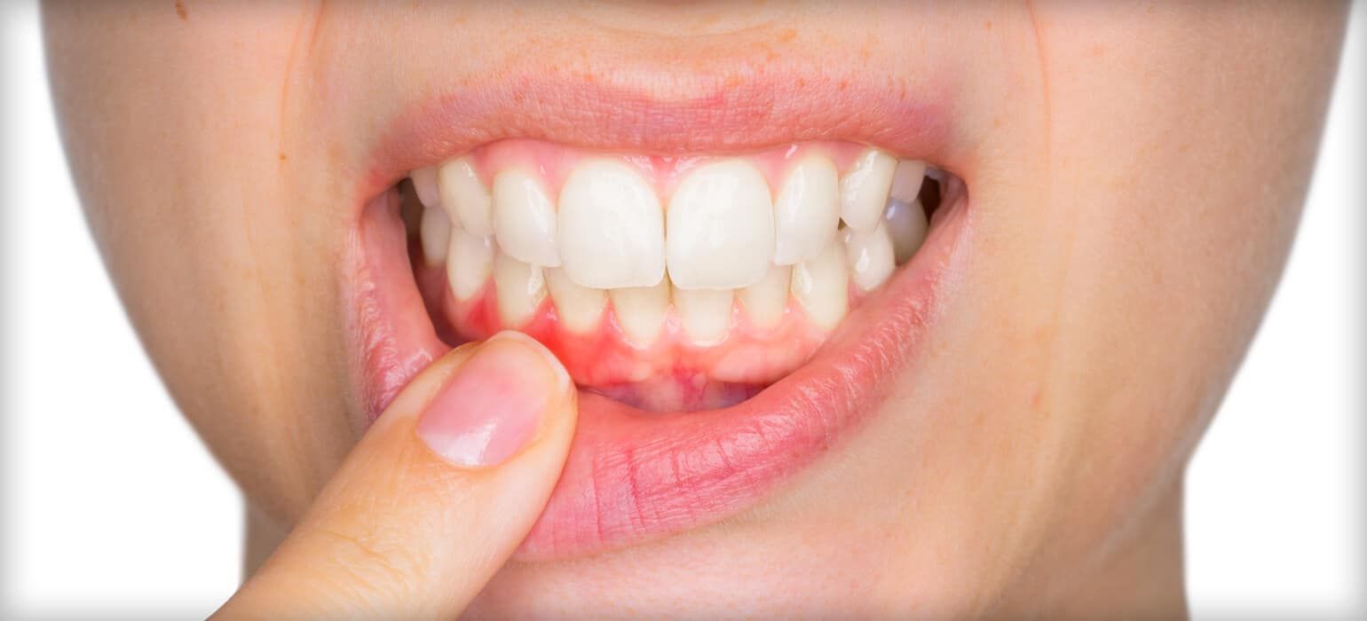 Close-up of a person's mouth showing inflamed gums. A finger points to the red, swollen area.