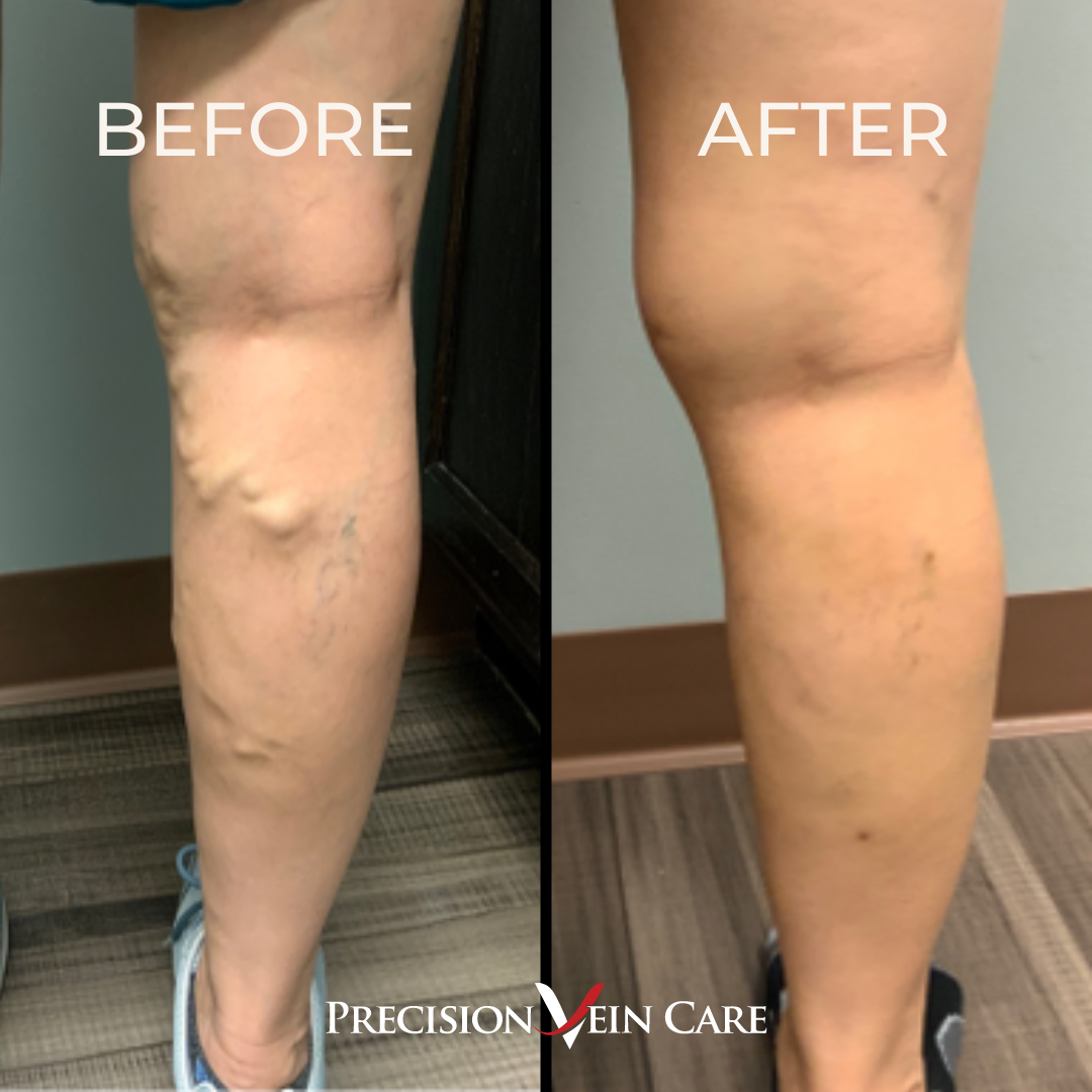 before and after vein treatment at precision vein care - real patient