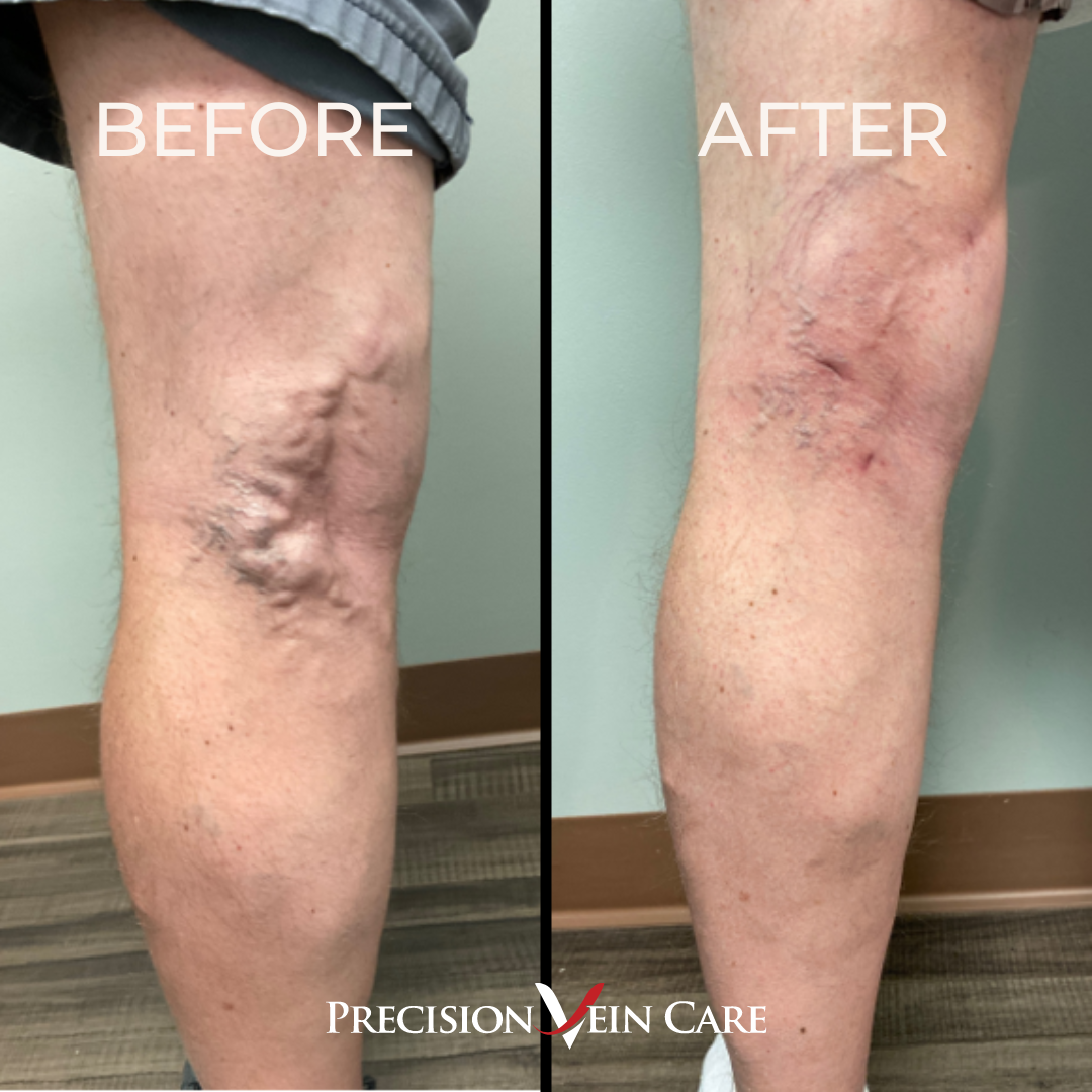 before and after vein treatment at precision vein care - real patient