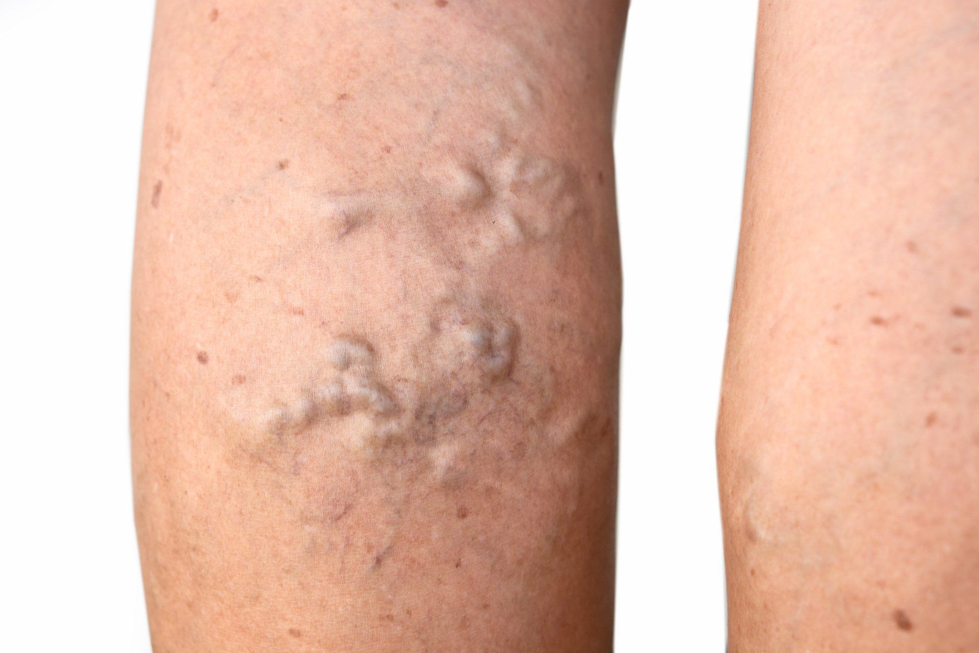 A close up of a person 's leg with varicose veins.