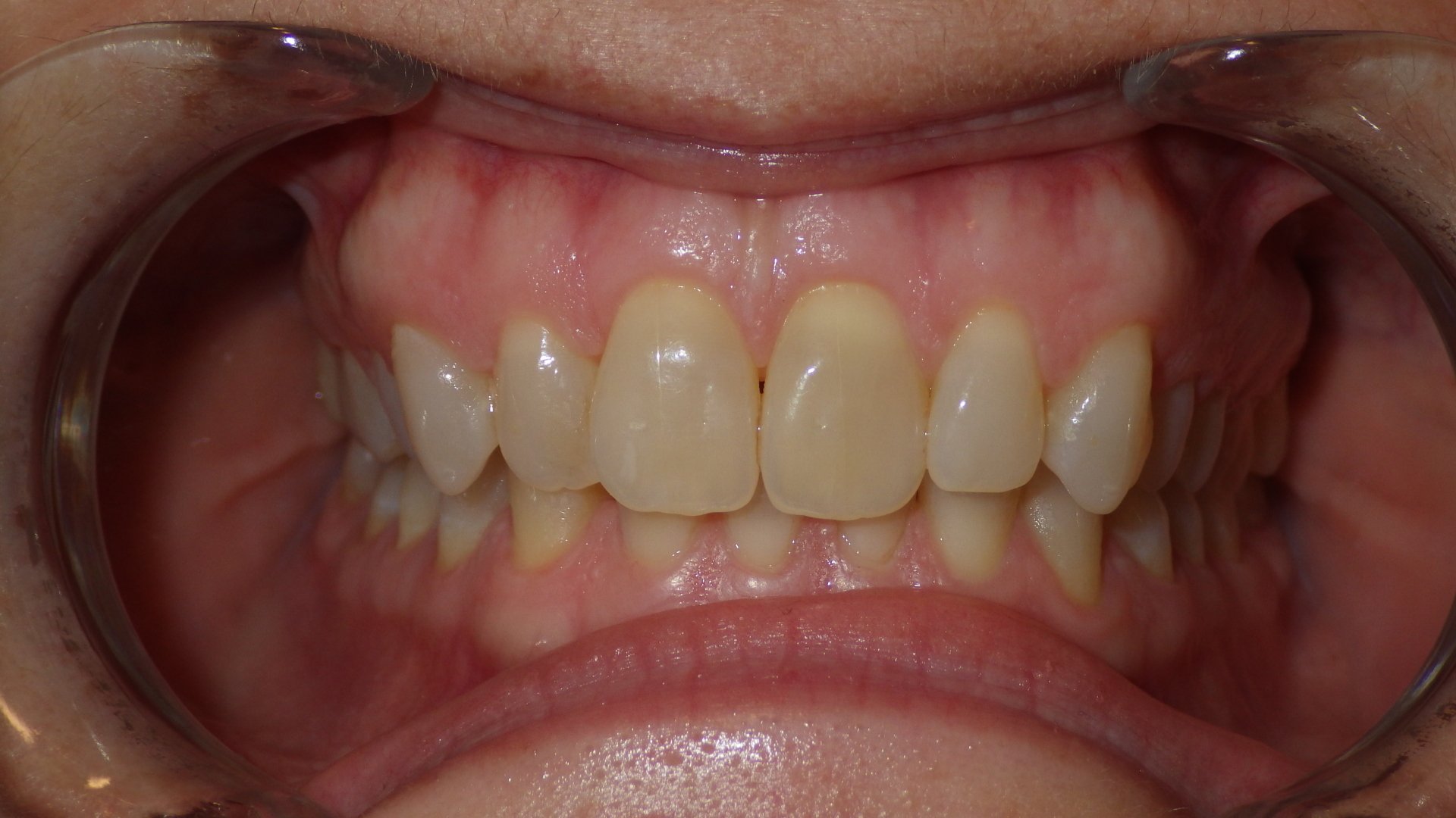 Dentist in Painted Post NY Dentist 14870