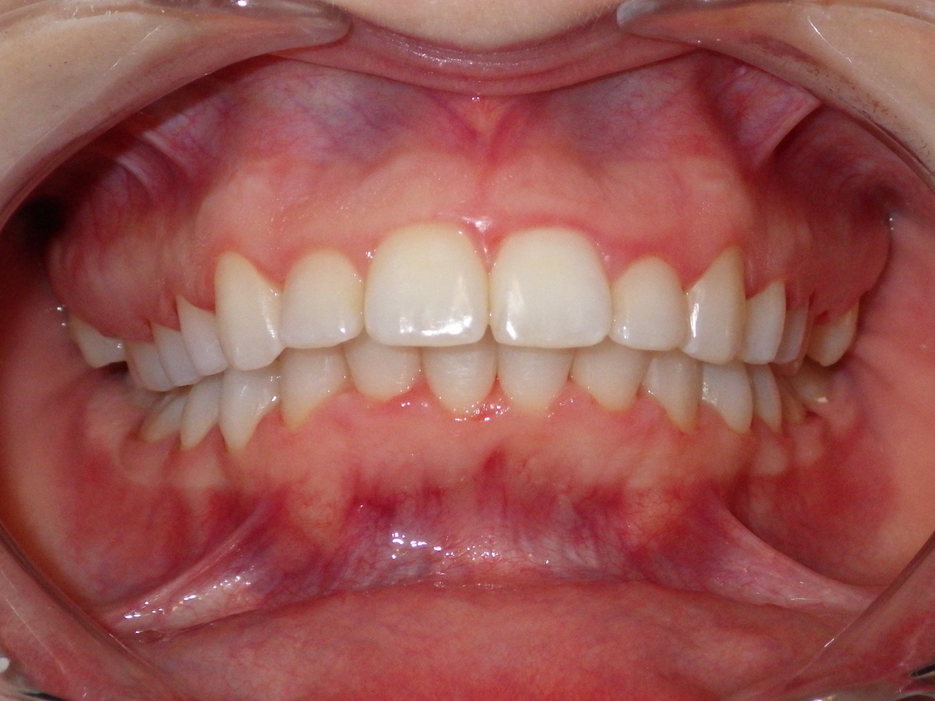 Dentist in Painted Post NY Dentist 14870