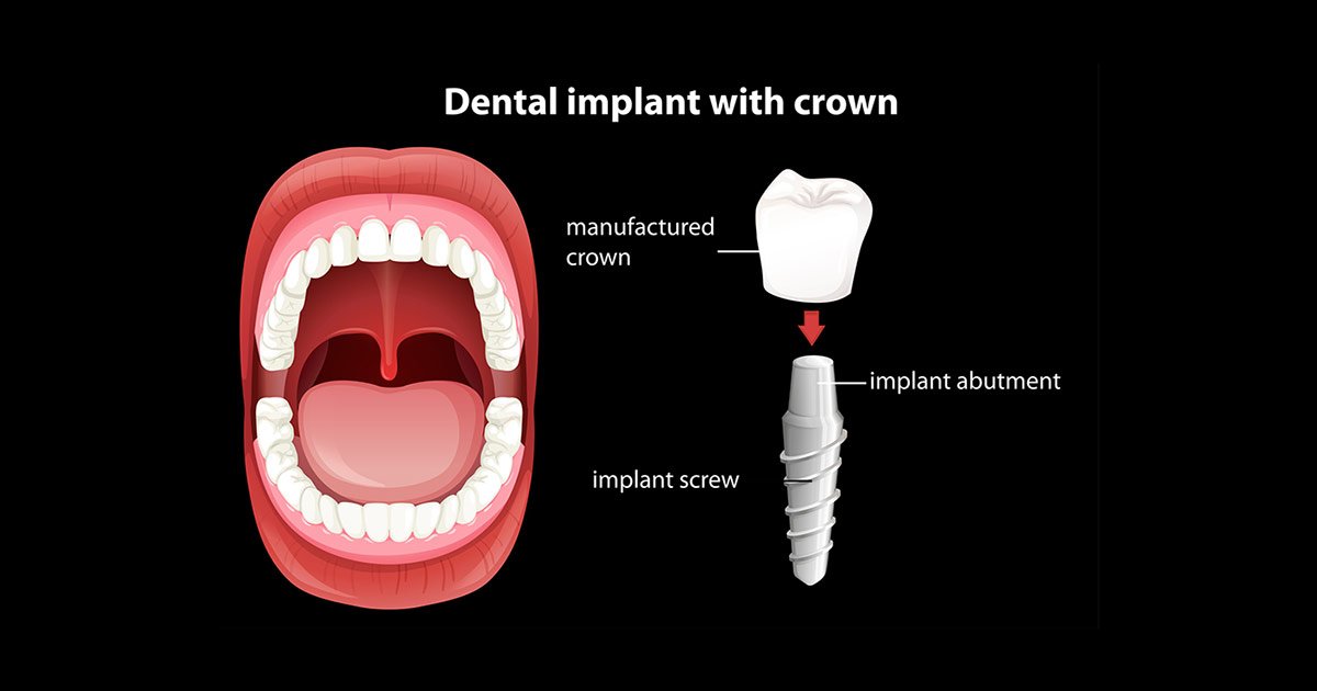 Everything You Need to Know About Dental Crowns