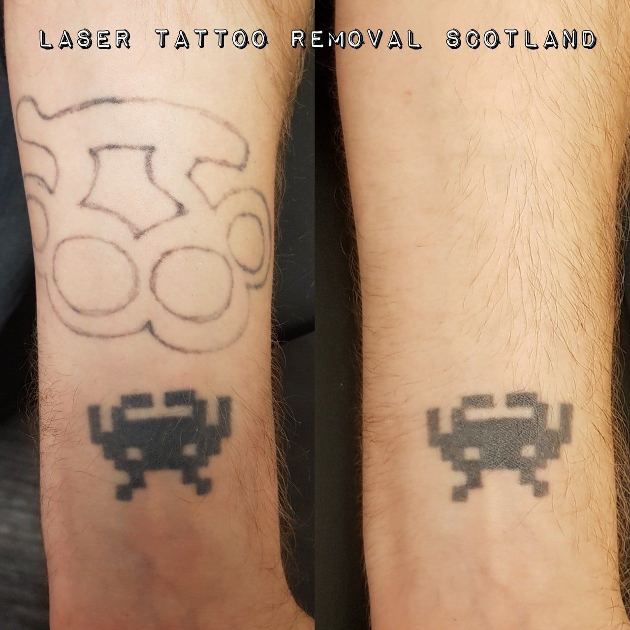 A before and after picture of a laser tattoo removal bodyland