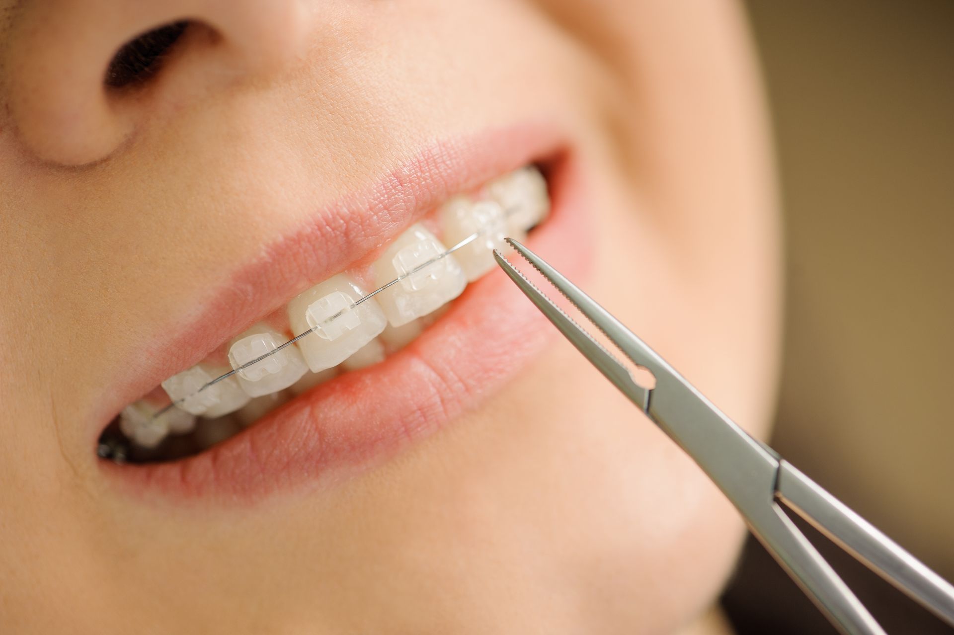 Close-up of ceramic braces being adjusted with orthodontic pliers during dental treatment.