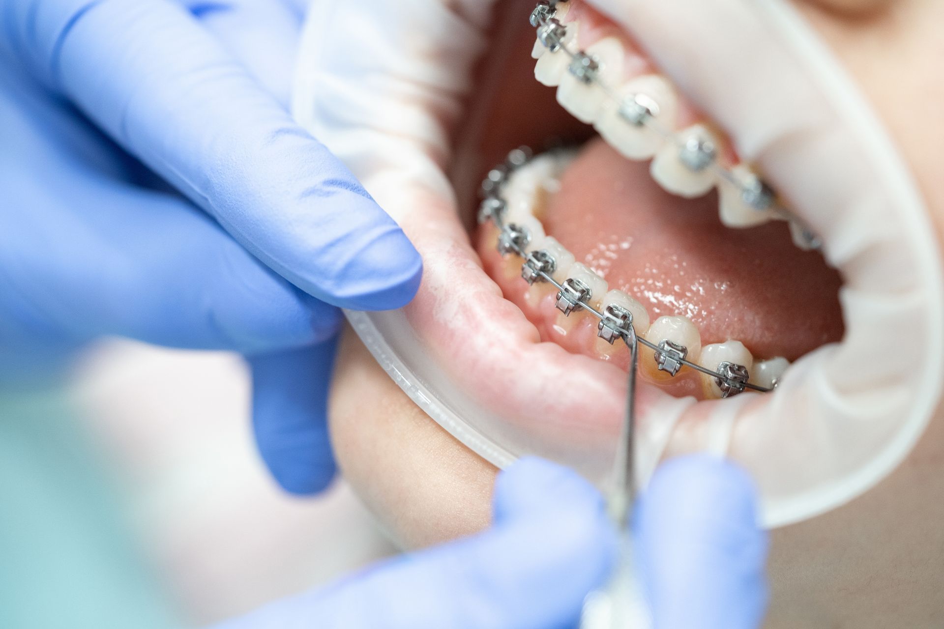 Close-up of dental braces adjustment during routine pediatric health check ups for teens.