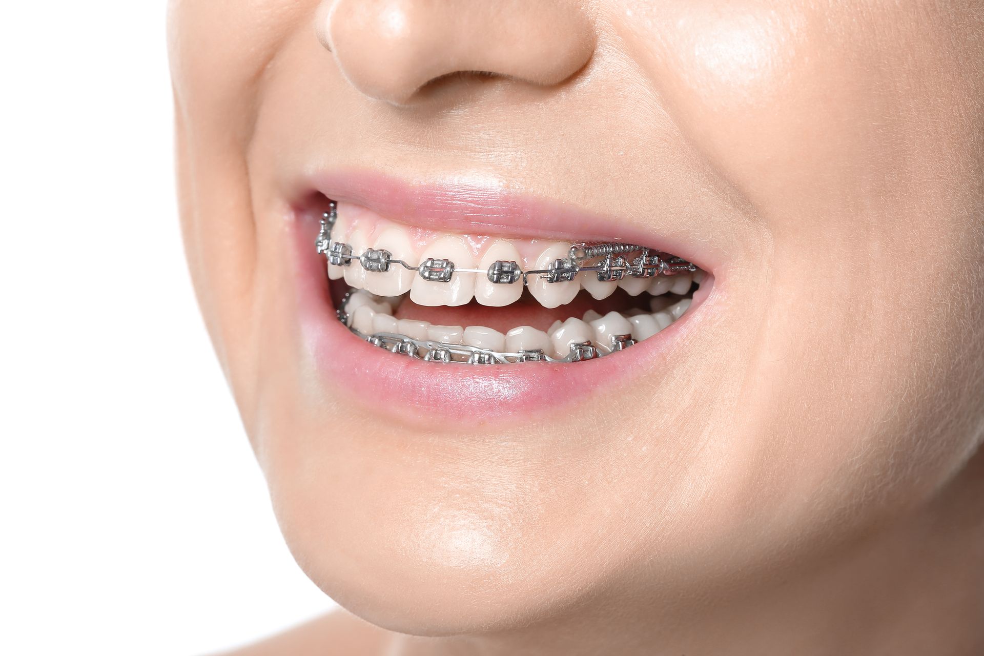 Close-up of a smiling mouth with metal braces on the teeth