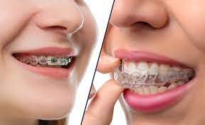 Orthodontic Retainer — Jackson, MS — Eugene C. Brown, Jr., DDS, MS