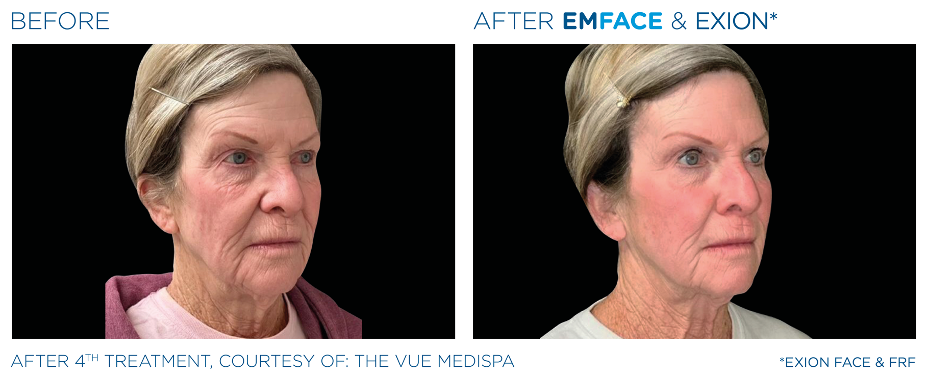 EMFACE before and after result card