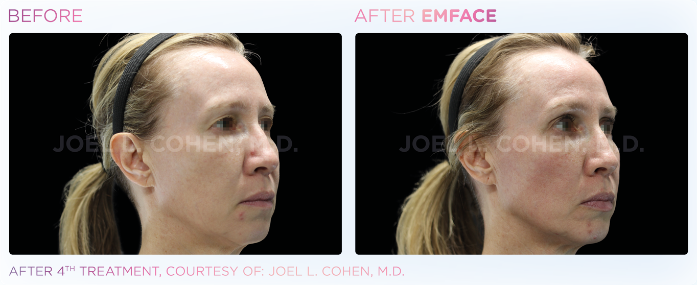 EMFACE before and after facial result