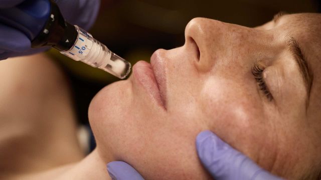 SkinPen aftercare and recovery information