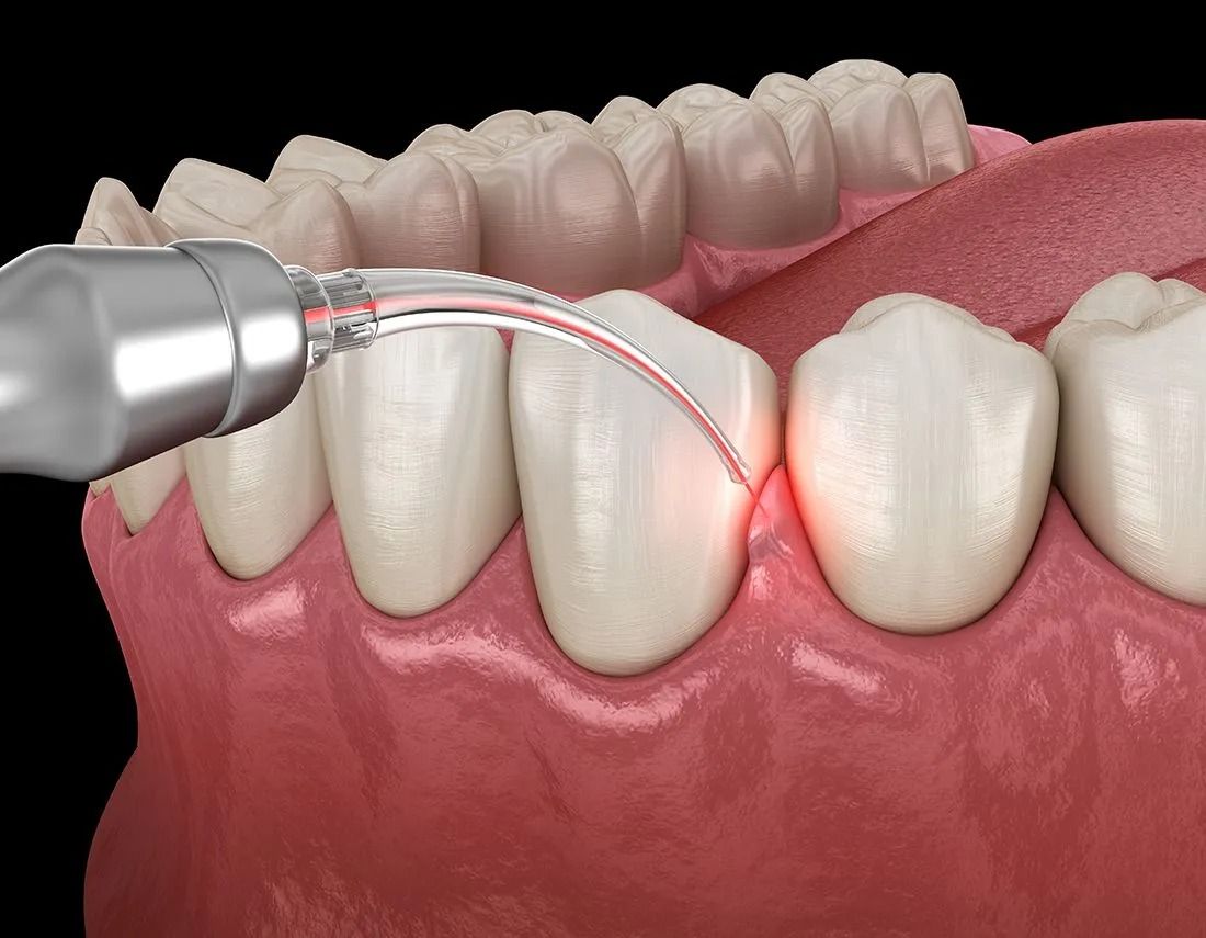 Pulizia interdentale con strumento dentale e luce rossa sulle gengive