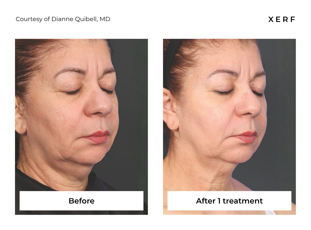 Before-and-after side-by-side face photos showing reduced under-eye puffiness after treatment.