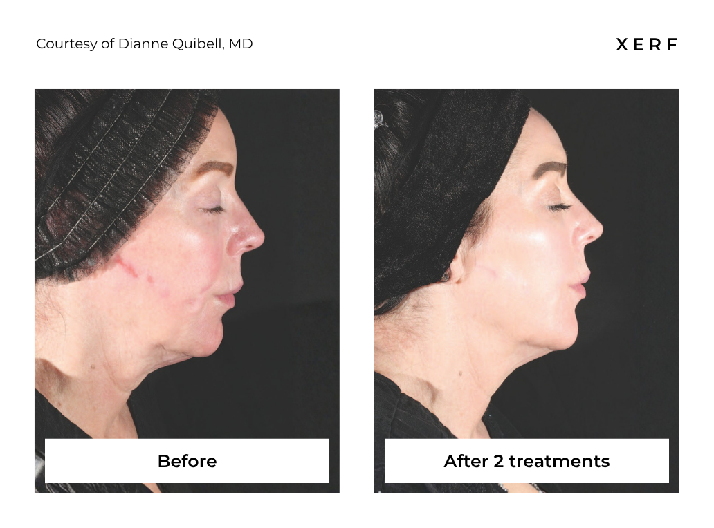Side-by-side profile photos of a face before and after two treatments, showing reduced redness.