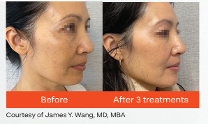 Before-and-after facial photos showing reduced swelling and sagging after treatment