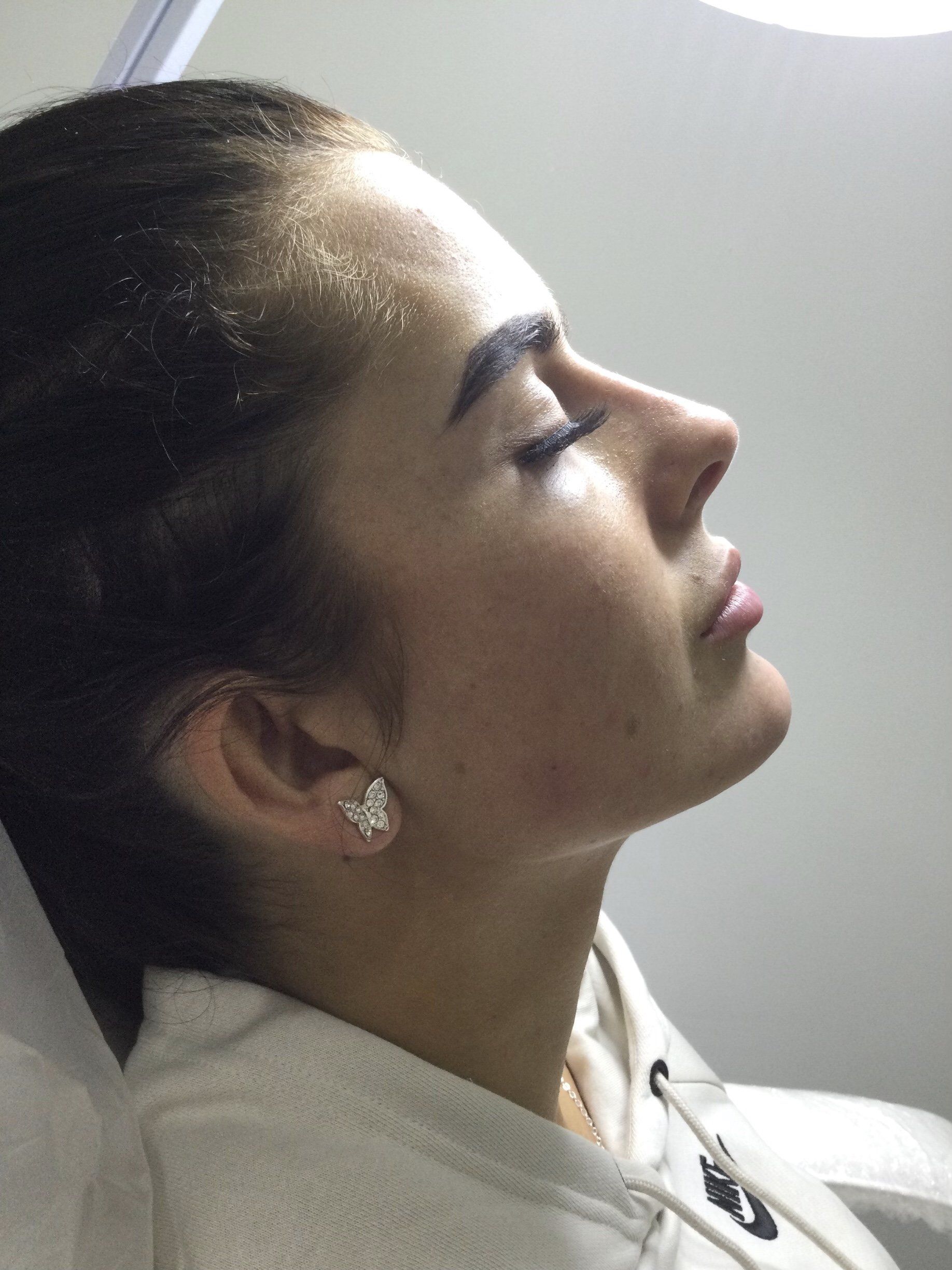 Rhinoplasty nose, chin, and lip fillers - After