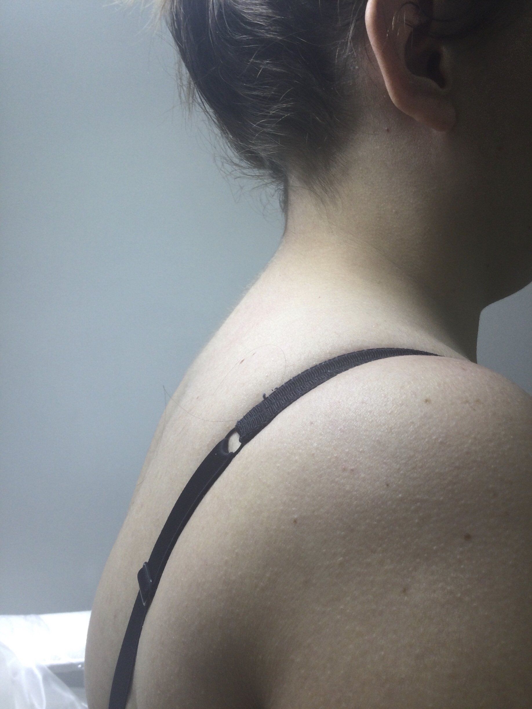 Buffalo hump after fat dissolving injections - After