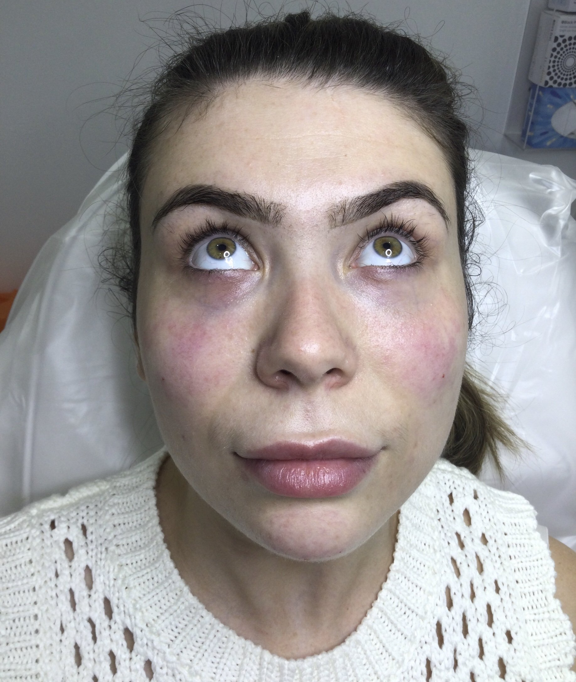 Chin fillers - After