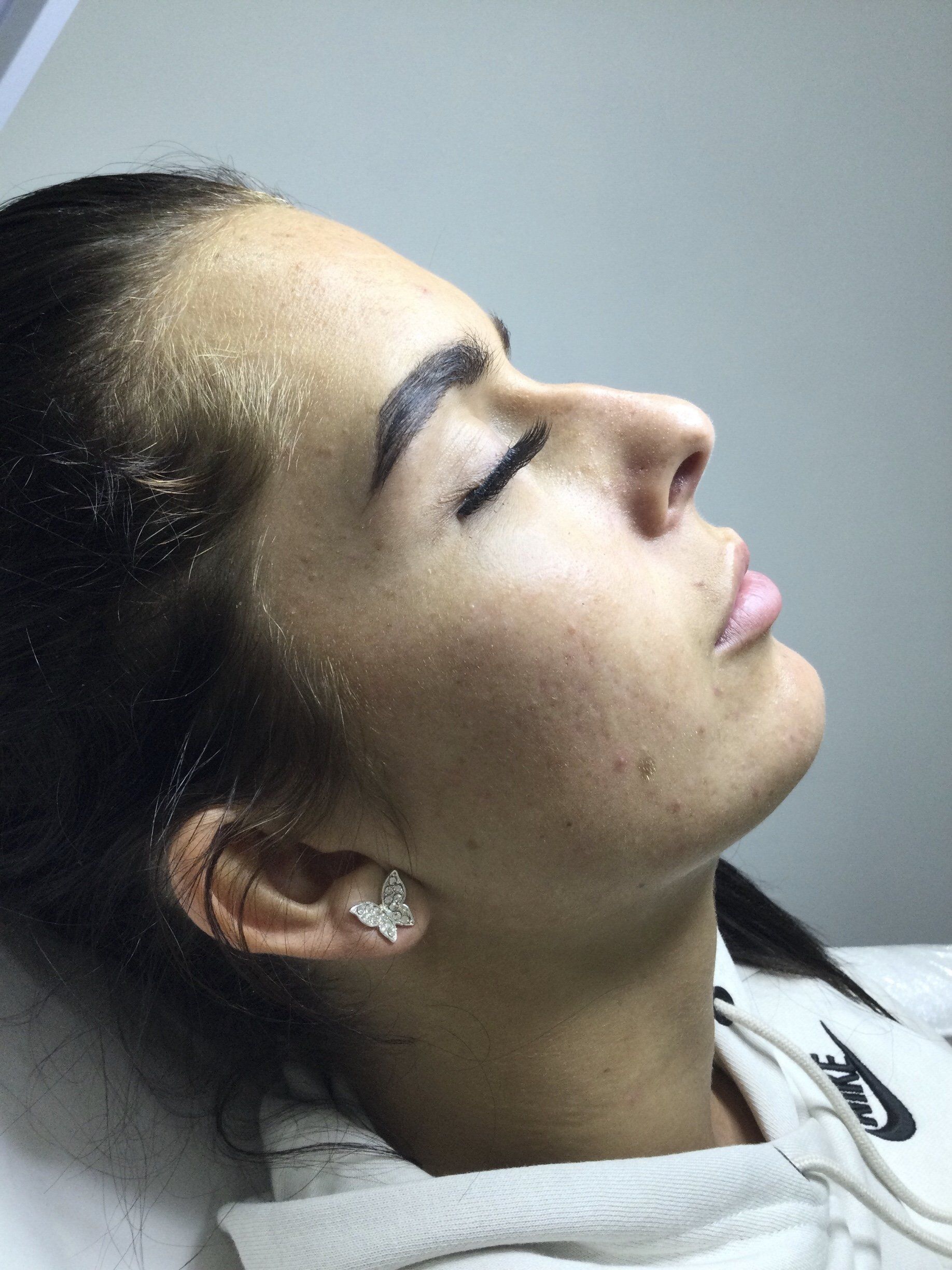 Rhinoplasty nose, chin, and lip fillers - Before