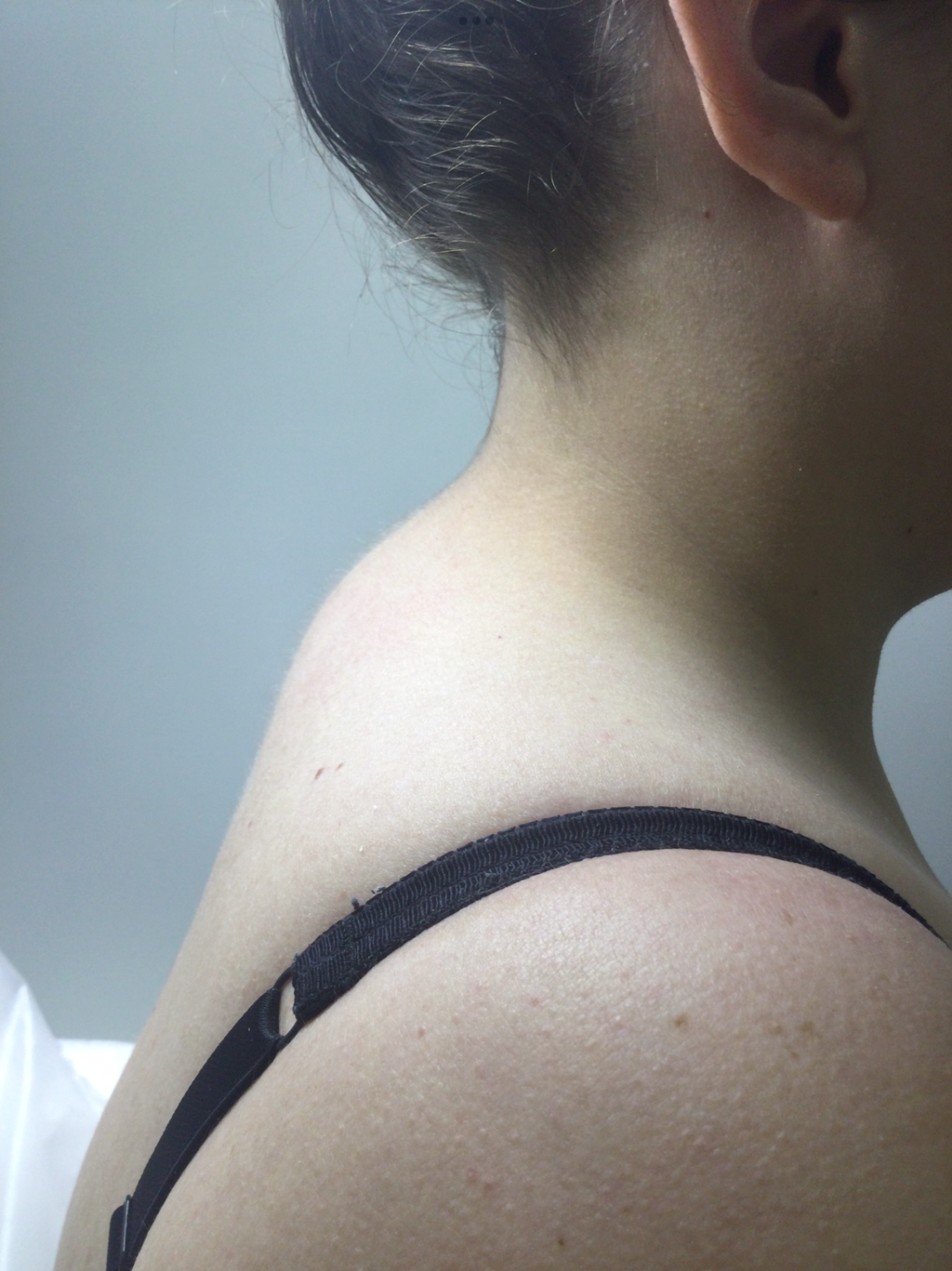Buffalo hump after fat dissolving injections - Before