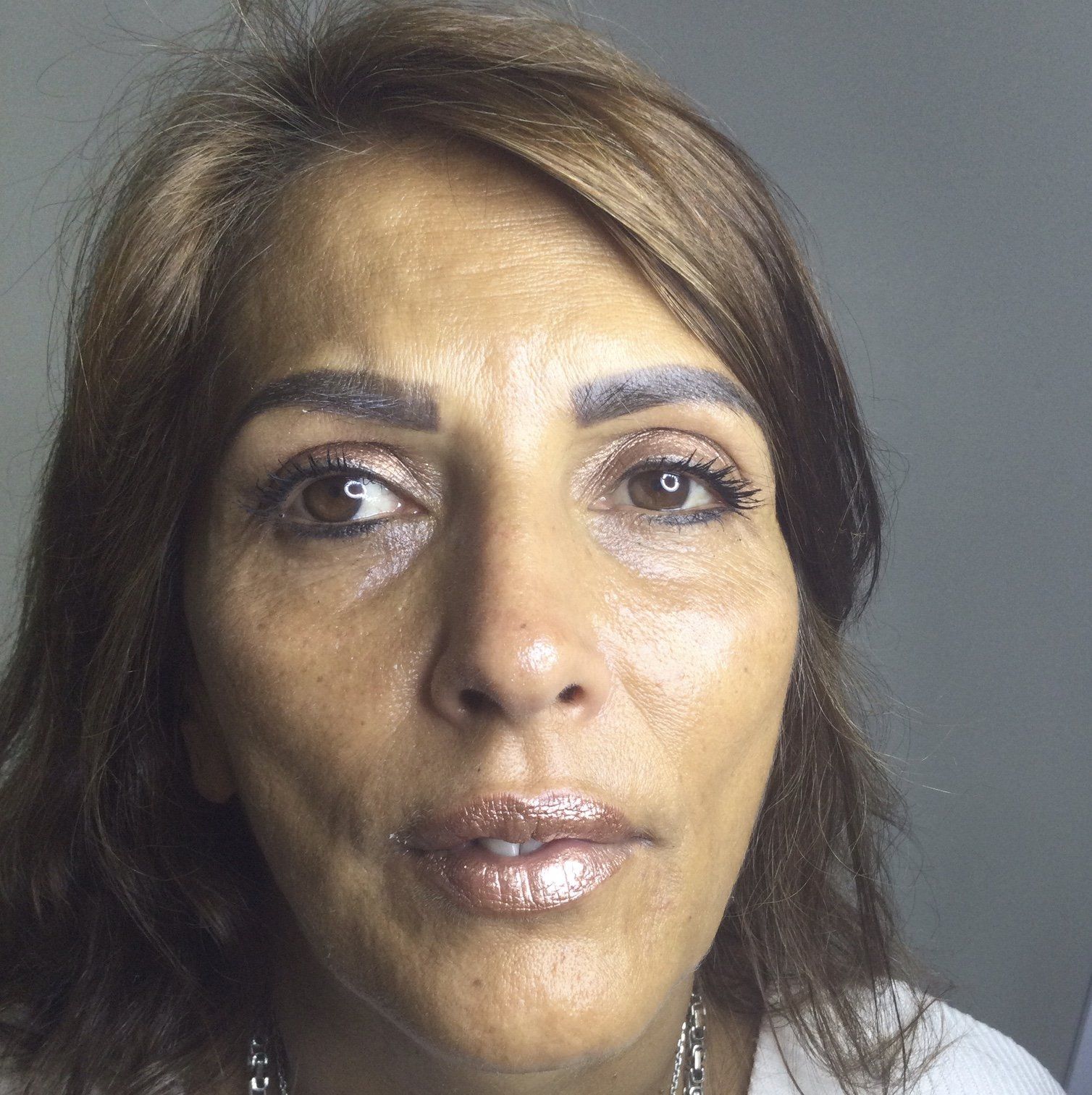 before skin boosting injections, tear through fillers and anti wrinkle injections - Before
