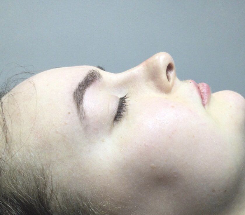 Rhinoplasty Nose Fillers 2 - After