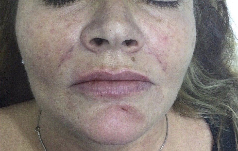 lip fillers and Nasolfolds Filler - After