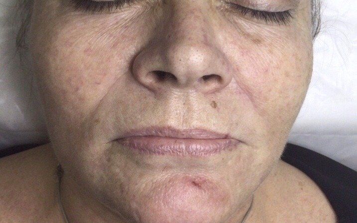 lip fillers and Nasolfolds Filler - Before