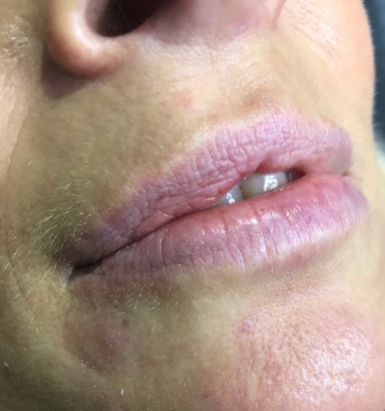 Lip Fillers - Before