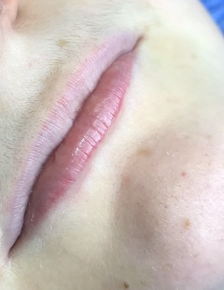 Lip Fillers - Before