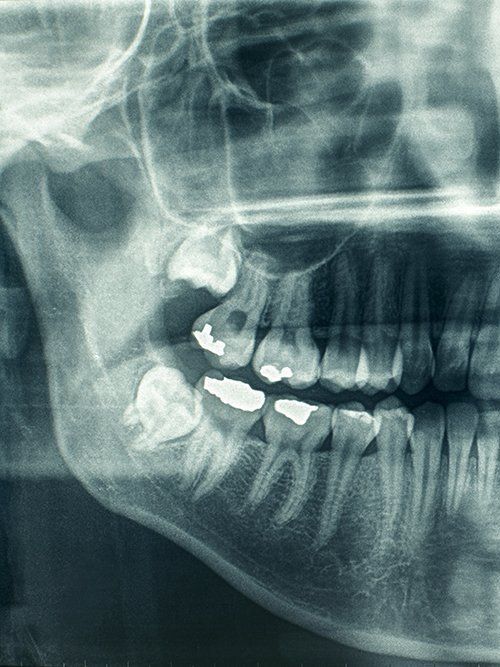 Una radiografia dei denti e del cranio di una persona.