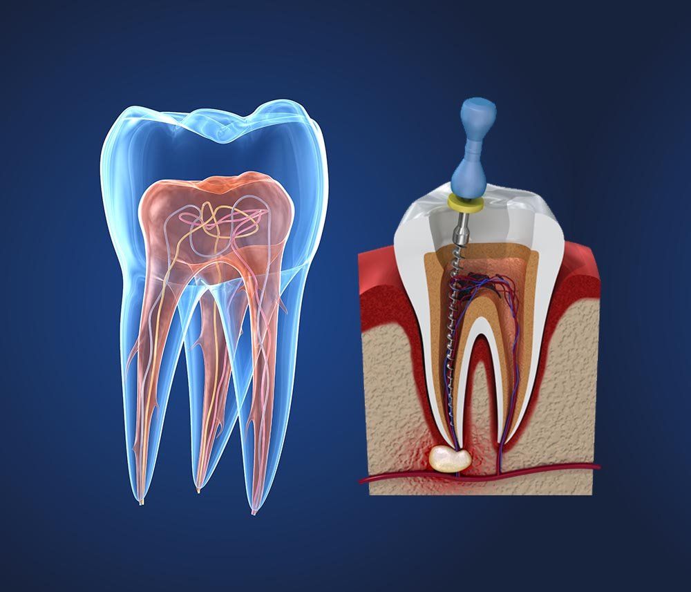 Una foto di un dente e una foto di una devitalizzazione
