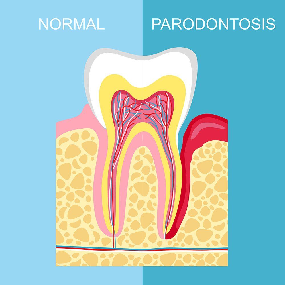 Uno schema di un dente normale e di un dente parodontale