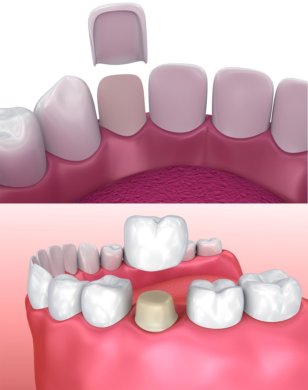 Un'illustrazione di una corona dentale posizionata su un dente