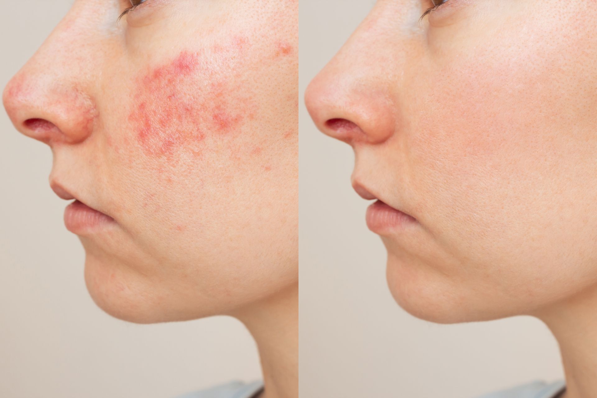 Side-by-side profile of a cheek before and after acne treatment, showing red blemishes fading to clear skin