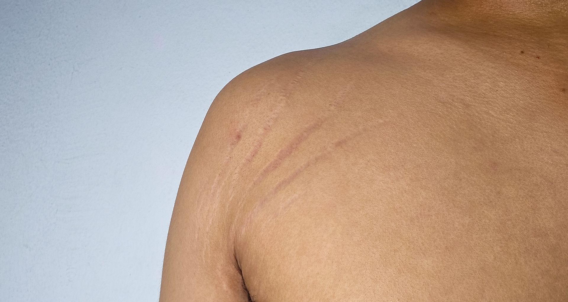 Close-up of a bare shoulder and upper back with visible stretch marks against a light background