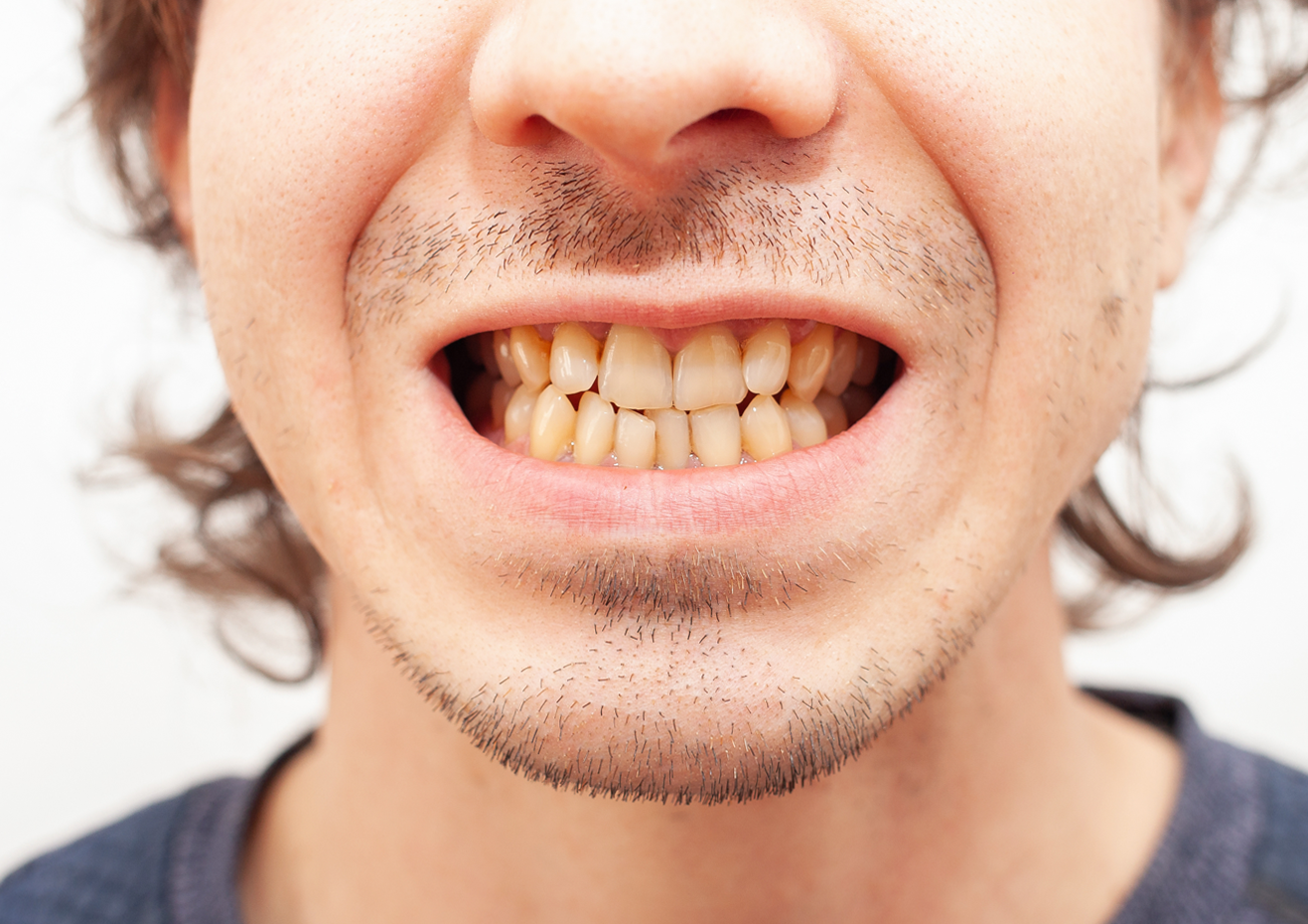 Un primer plano de la boca de un hombre con barba que muestra sus dientes.